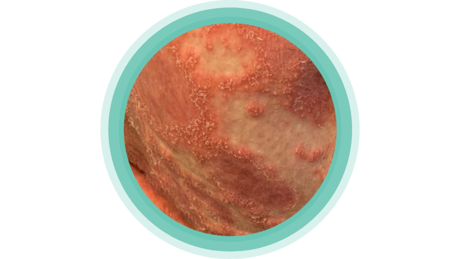 bőrreakciók, kiváltó okok, kiterjedt pustulák, GPP betegség kezelése, Act4GPP